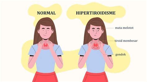Hipertiroidisme Gejala Penyebab Dan Pengobatan Medkes