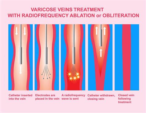 How Varicose Vein Surgery Is Done Dekalb Vein Center