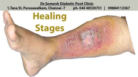 Cellulitis Healing Stages My Xxx Hot Girl