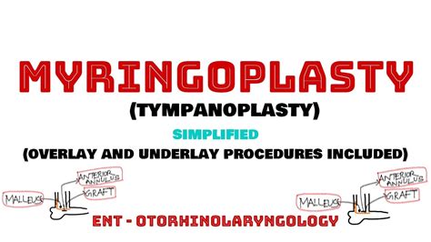 Myringoplasty Tympanoplasty Ear Surgeries Overlay And Underlay