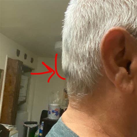My Dad Has This Strange Lump On The Back Of The Head He Just Found It