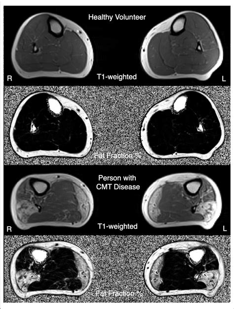 Example T1 Weighted Mri Images And Three Point Dixon Mri Obtained