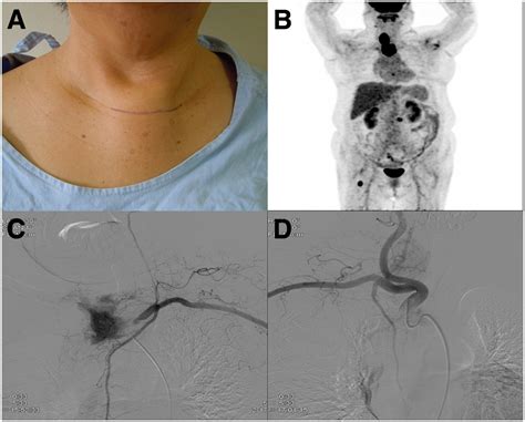 Selective Embolization For Hypervascular Metastasis From Differentiated