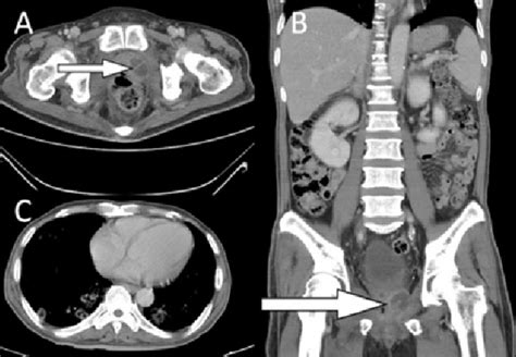 The Contrast Enhanced Ct Scan Of The Abdomen Pelvis And Lung The