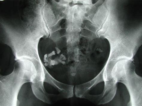 A Teething Problem Ovarian Teratoma Causing Hip Pain Eurorad