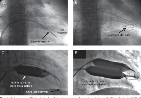 Figure 1 From A Novel Technique For Multi Track Percutaneous Balloon Mitral Valvoplasty