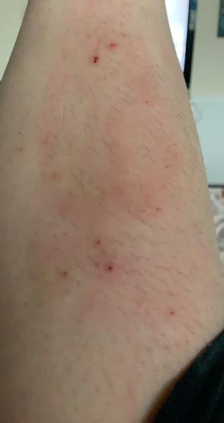 Itchy Patch On Lower Leg Mumsnet