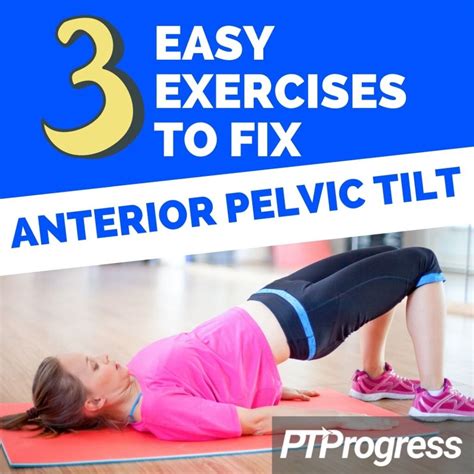 How To Fix Anterior Pelvic Tilt