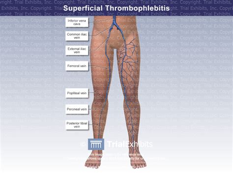 Superficial Thrombophlebitis Trial Exhibits Inc