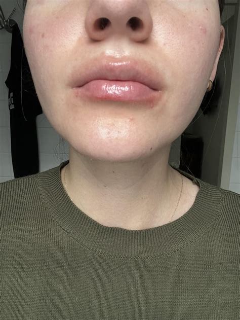 Persisting Lip Rash For 2 Months Rdermatologyquestions