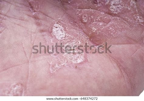 Psoriasis Skin Disease On Joints Body Stock Photo 648374272 Shutterstock
