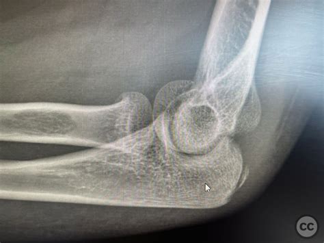 Radial Head And Incomplete Capitellum Fracture