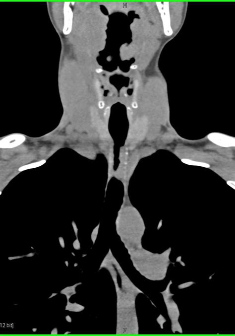 Tracheal Stenosis Due To Inflammatory Stricture Chest Case Studies