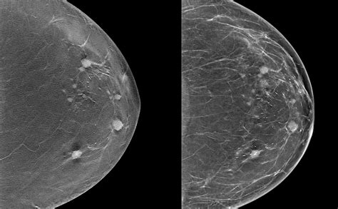 Digital Breast Tomosynthesis Appears Superior For Invasive Breast