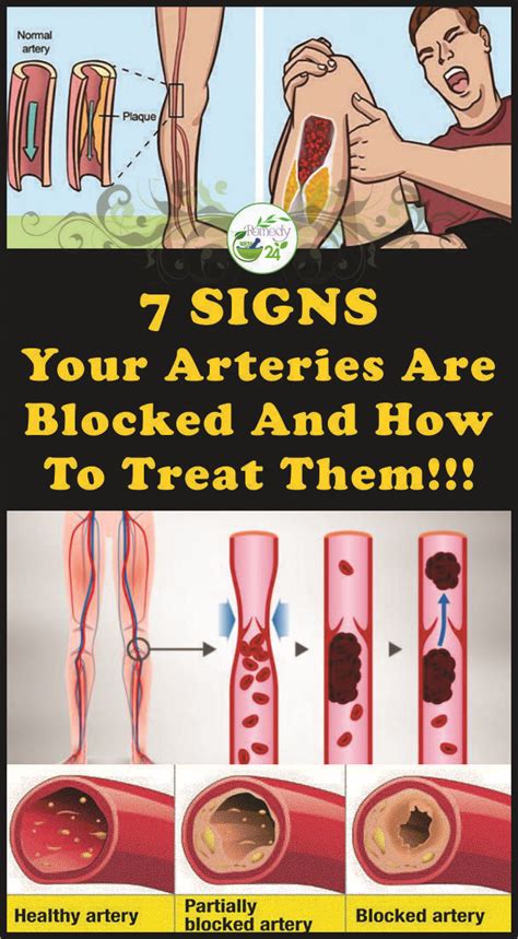 7 Signs Your Arteries Are Blocked And How To Treat Them Arteries