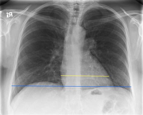 ロイヤリティフリー Normal X Ray Of Heart さととめ