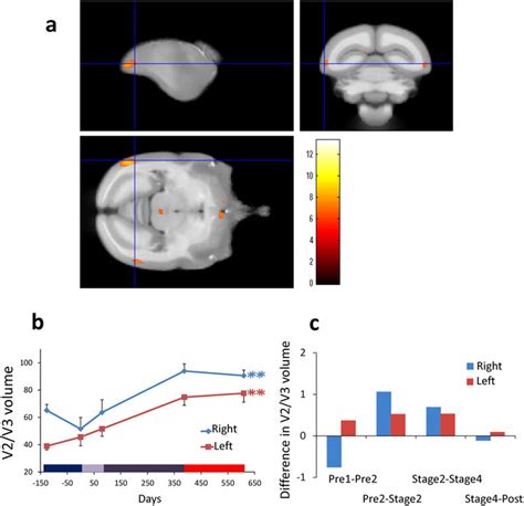 Gray Matter Increases In Bilateral Lateral Extrastriate Cortex