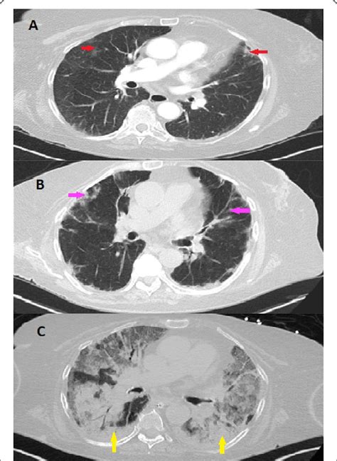 Computed Tomography Of The Chest Ct Scan Of The Chest With Contrast