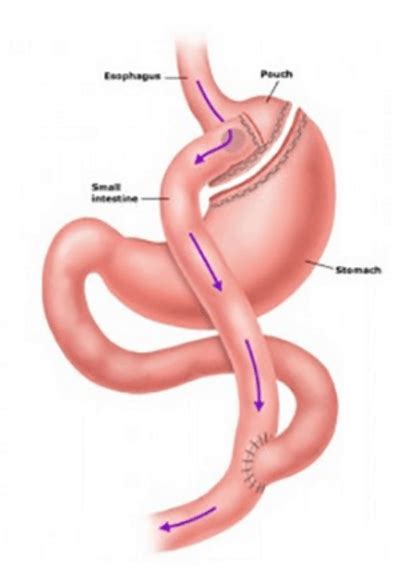 Gastric Bypass Surgery By Expert Surgeon In Dallas And Plano Dr Malladi