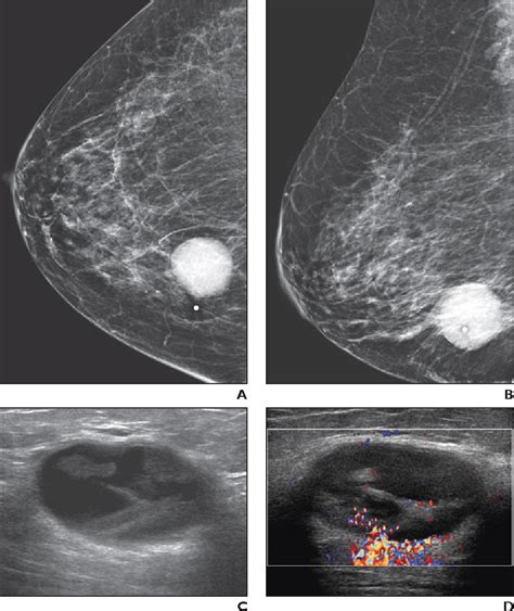 Figure 1 From Cystic Masses Of The Breast Semantic Scholar