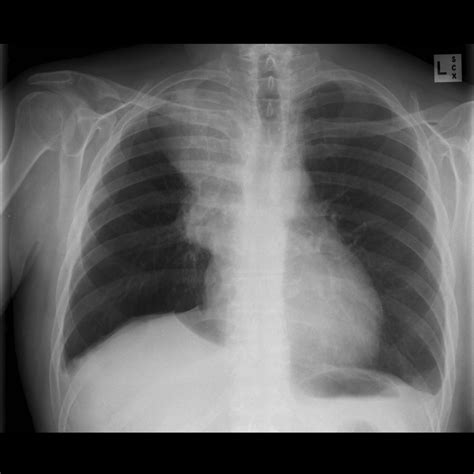 Kleinzelliges Bronchialkarzinom Röntgen Thorax DocCheck