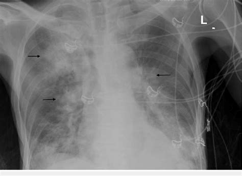 Chest Radiograph Showing Diffuse Opacification And Emphysematous