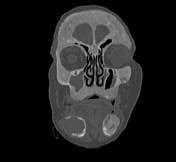 Renal Osteodystrophy Radiology Reference Article Radiopaedia Org