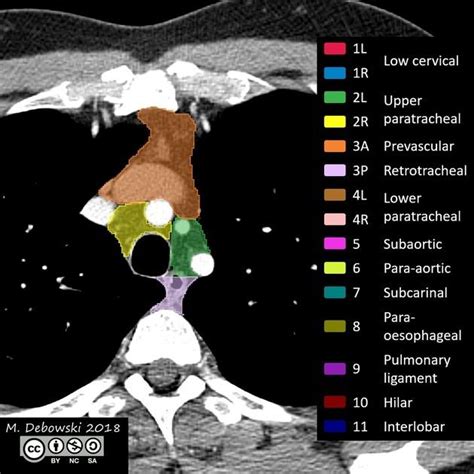 Thoracic Lymph Node Stations Annotated Ct Radiology Case