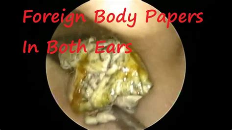 Foreign Body Papers Removal From Both Ears In Small Child Youtube