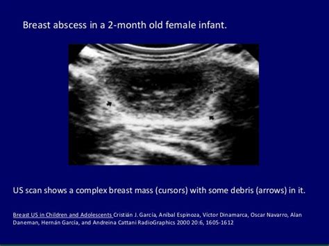 Ultrasound Of Pediatric And Adolescent Breast