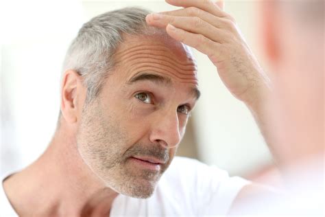 The 7 Common Stages Of Hair Loss Distefano Hair Restoration Center