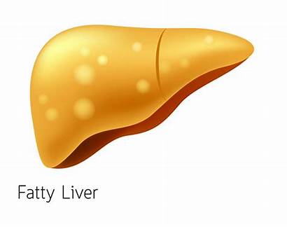 Liver Fatty Clipart Disease Alcohol Alcoholic Early