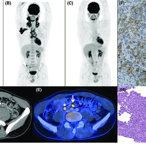 Pdf Petct Imaging In Management Of Concomitant Hodgkin Lymphoma And