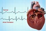 Images of Marijuana And Afib