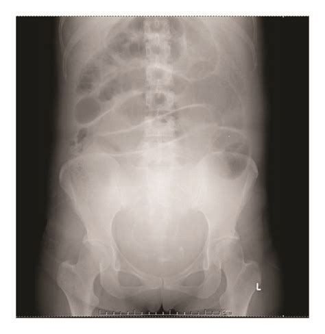 Abdominal X Ray Showed Air Fluid Level Of Small Intestine And Dilated