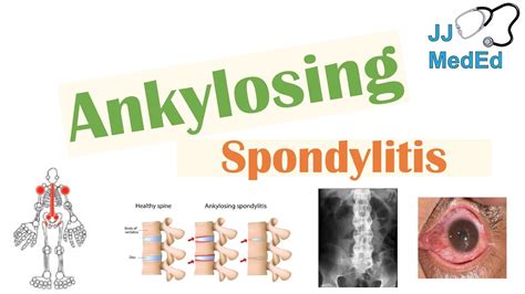 Ankylosing Spondylitis Hla B27 Pathophysiology Signs And Symptoms