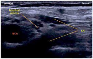 Bloqueo Supraclavicular Del Plexo Braquial Guiado Por Ultrasonido