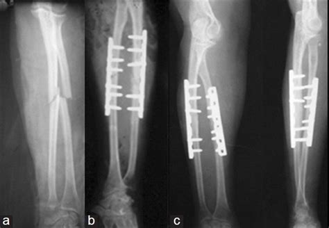 A Preoperative X Ray Of The Forearm Shows Fracture Of Both Bones B