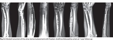 Figure 4 From Management Of Infected Nonunion Of The Forearm By The
