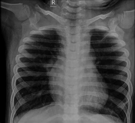 Chest X Ray Showing Mild Cardiomegaly And Very Minimal Pulmonary