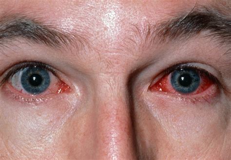 How Long Is Pink Eye Contagious Here Are Signs To Know