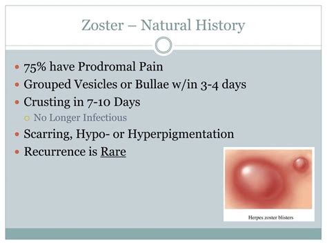 Ppt Herpes Zoster And Post Herpetic Neuralgia Powerpoint Presentation