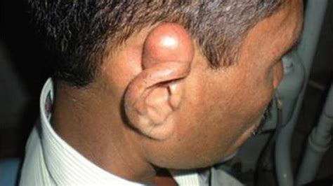 Earlobe Cyst Causes Symptoms And Treatment