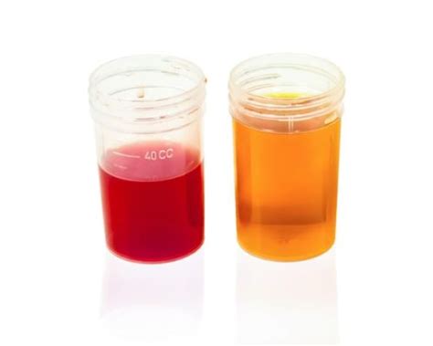 Why Its So Important To Look At Your Urine
