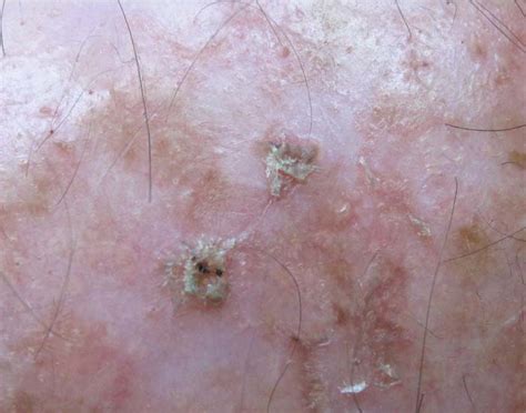 Skin Cancer Actinic Keratosis Pictures