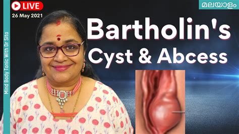 Bartholin Cyst മലയള Abscess Symptoms Treatment
