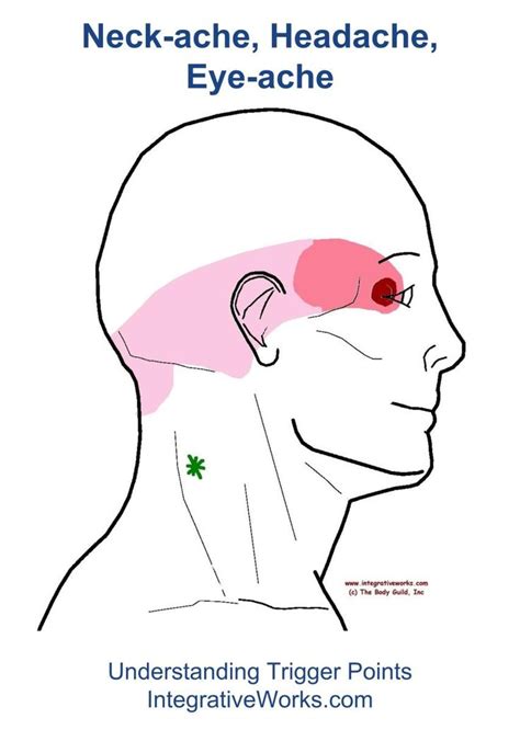 The Pain Pattern Of Splenius Cervicis That Creates That Dull Headache