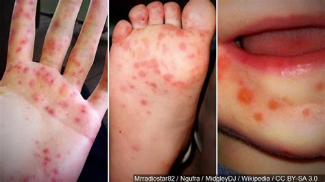 hand foot and mouth disease outbreak hits johns hopkins university wjla