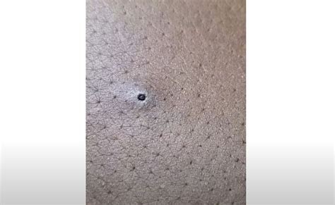 Deep Blackhead Removal New Pimple Popping Videos