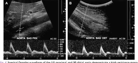 Figure 2 From Sonographic Evaluation Of The Abdominal Aorta Semantic Scholar